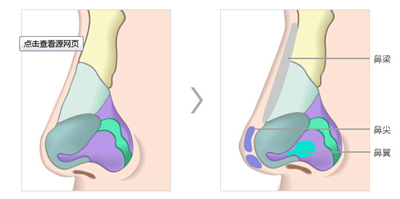 硅胶隆鼻
